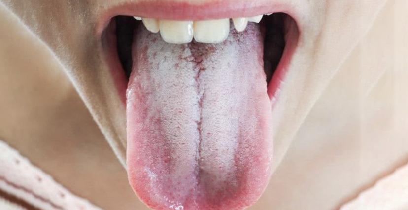舌苔发白很厚是什么原因