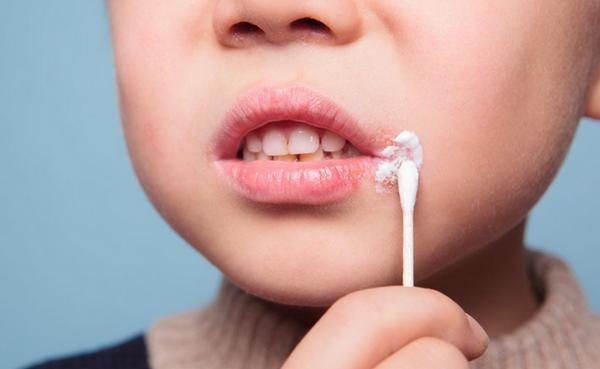 口角炎是什么原因造成的
