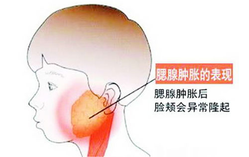 腮腺炎的早期症状 腮腺炎怎么治疗