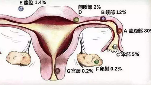 宫外孕会来月经吗 宫外孕怎么办