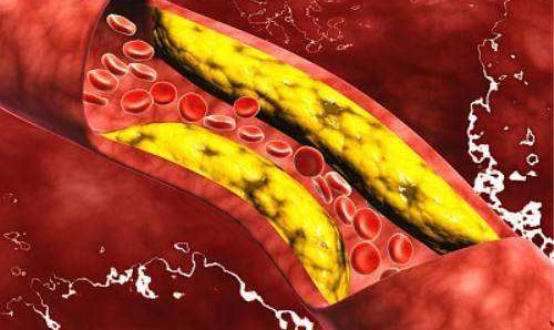 总胆固醇高是怎么回事 胆固醇高的原因