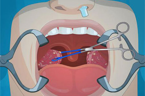 扁桃体化脓怎么办 扁桃体化脓要注意什么