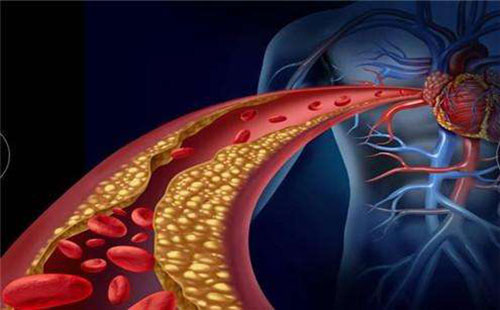 胆固醇高的危害 胆固醇偏高怎么办