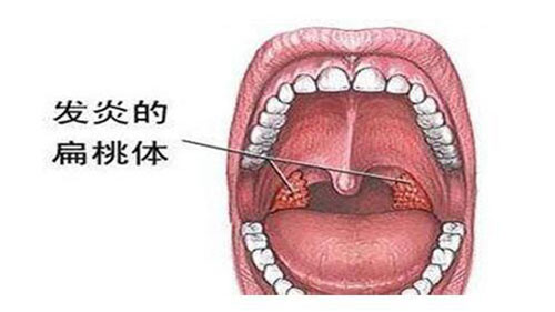 扁桃体发炎怎么办 扁桃体发炎的原因