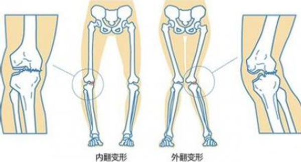 佝偻病缺什么 佝偻病是因为缺什么营养